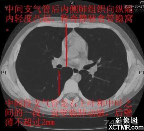 胸部CT断层解剖纵隔血管气管分支标注详解