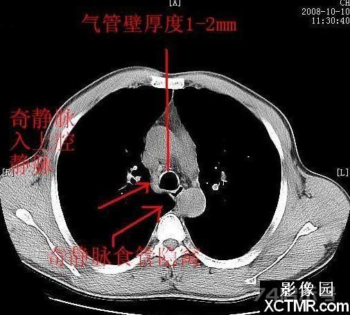 胸部CT断层解剖纵隔血管气管分支标注详解