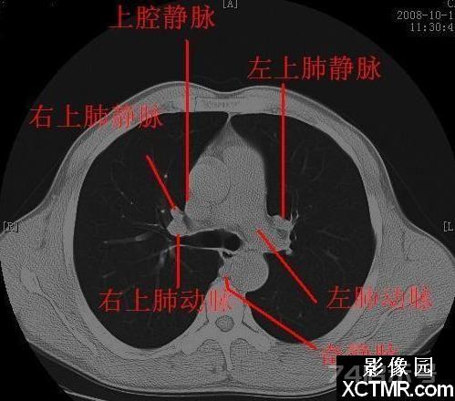 胸部CT断层解剖纵隔血管气管分支标注详解