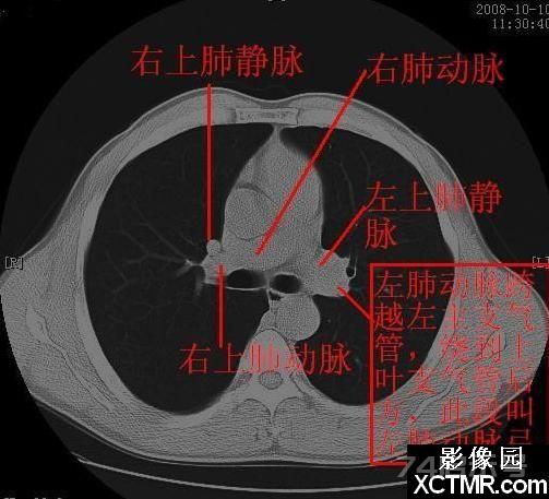 胸部CT断层解剖纵隔血管气管分支标注详解