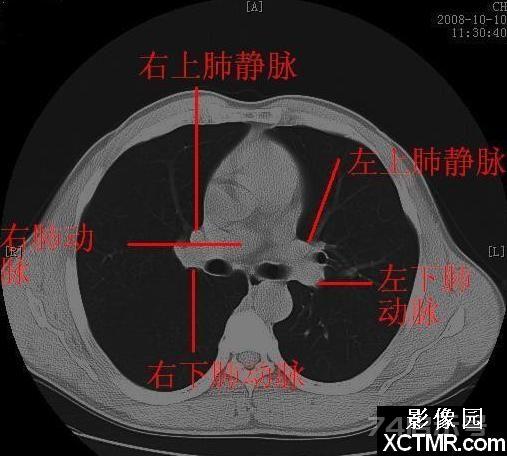 胸部CT断层解剖纵隔血管气管分支标注详解