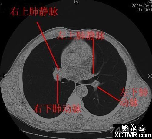 胸部CT断层解剖纵隔血管气管分支标注详解