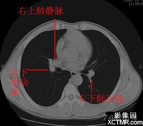 胸部CT断层解剖纵隔血管气管分支标注详解