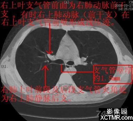 胸部CT断层解剖纵隔血管气管分支标注详解