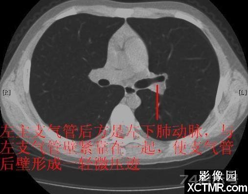 胸部CT断层解剖纵隔血管气管分支标注详解