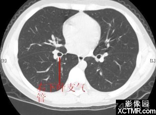 胸部CT断层解剖纵隔血管气管分支标注详解