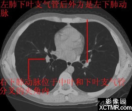 胸部CT断层解剖纵隔血管气管分支标注详解