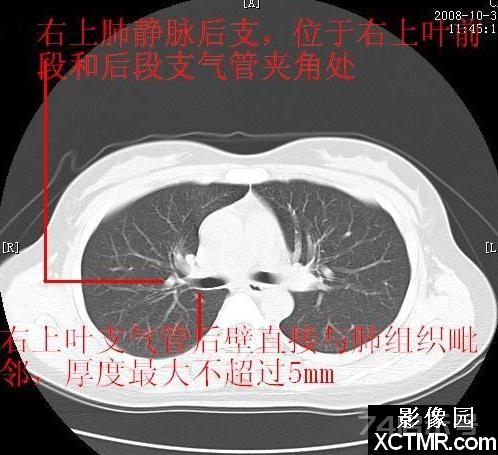 胸部CT断层解剖纵隔血管气管分支标注详解