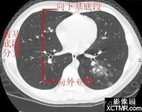 胸部CT断层解剖纵隔血管气管分支标注详解