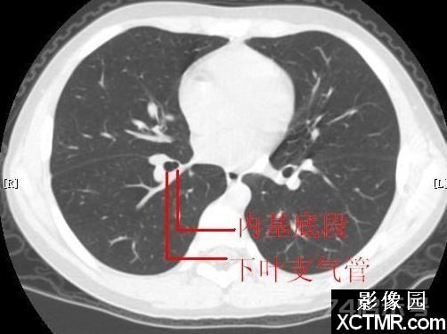 胸部CT断层解剖纵隔血管气管分支标注详解