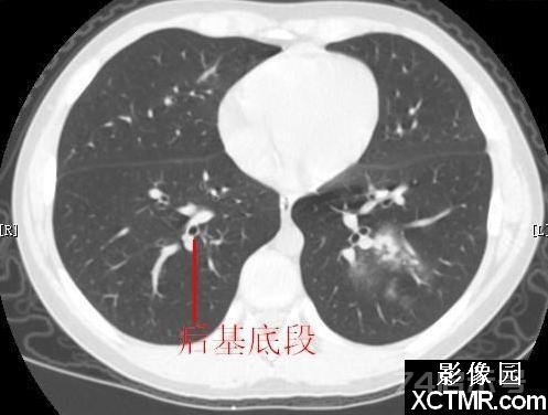 胸部CT断层解剖纵隔血管气管分支标注详解