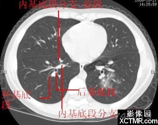 胸部CT断层解剖纵隔血管气管分支标注详解