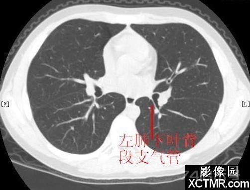 胸部CT断层解剖纵隔血管气管分支标注详解