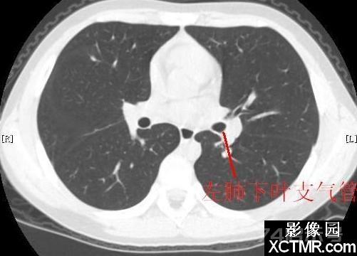 胸部CT断层解剖纵隔血管气管分支标注详解