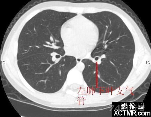 胸部CT断层解剖纵隔血管气管分支标注详解