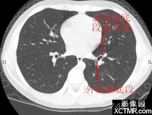 胸部CT断层解剖纵隔血管气管分支标注详解