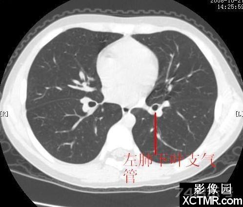 胸部CT断层解剖纵隔血管气管分支标注详解