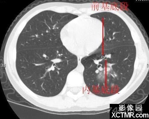 胸部CT断层解剖纵隔血管气管分支标注详解