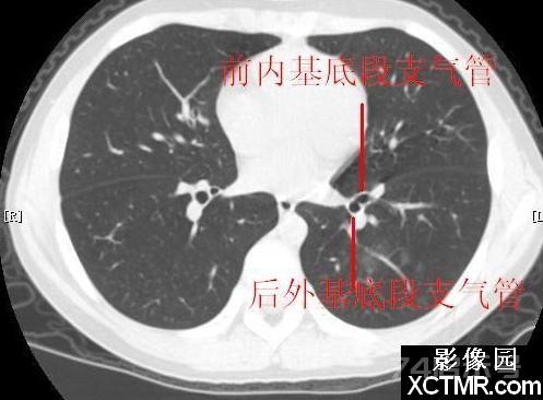 胸部CT断层解剖纵隔血管气管分支标注详解